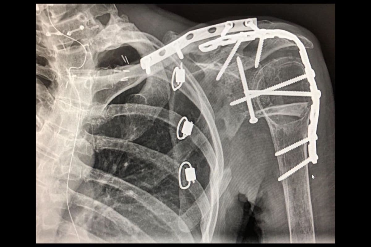 Durante una escena de acción que se filmaba en Sudáfrica, Olivia Jackson sufrió un accidente de motocicleta que la dejó 17 días en coma, quedó paralizada una cuarta parte de su cuerpo, tuvo los pulmones perforados, sus costillas se rompieron y perdió el brazo hasta por encima del codo, le quedaron algunas cicatrices en la cara y aún sufre daños nerviosos.