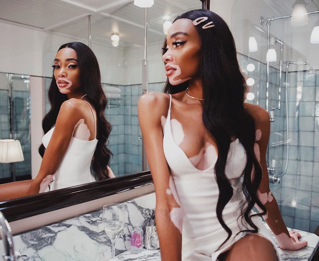 Winnie Harlow usa su plataforma para hablar sobre el vitiligo desde una perspectiva positiva a favor de aquellos que también han recibido este diagnóstico.
