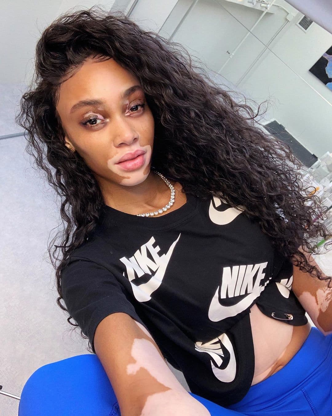 Chantelle Brown-Young es el verdadero nombre de la modelo, quien fue diagnosticada con vitiligo, enfermedad que provoca la pérdida de pigmentación en la piel, desde los cuatro años.